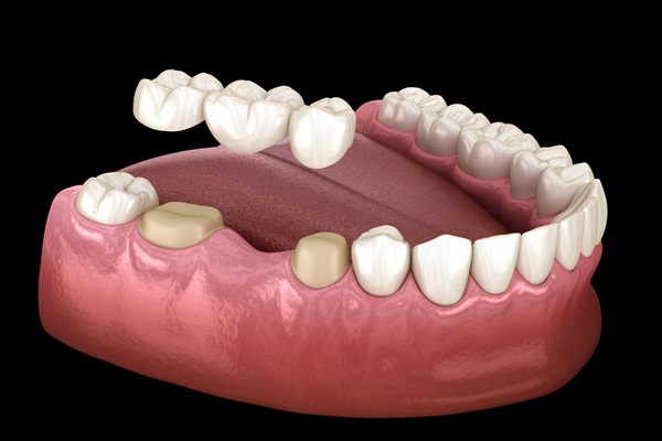 Are You A Candidate For Dental Bridges?