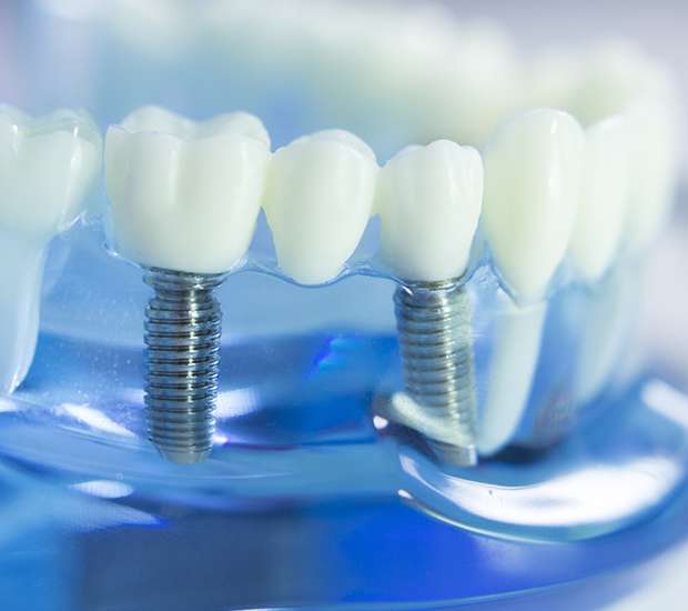 Thousand Oaks Dental Implants