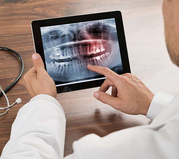 Thousand Oaks Types of Dental Root Fractures